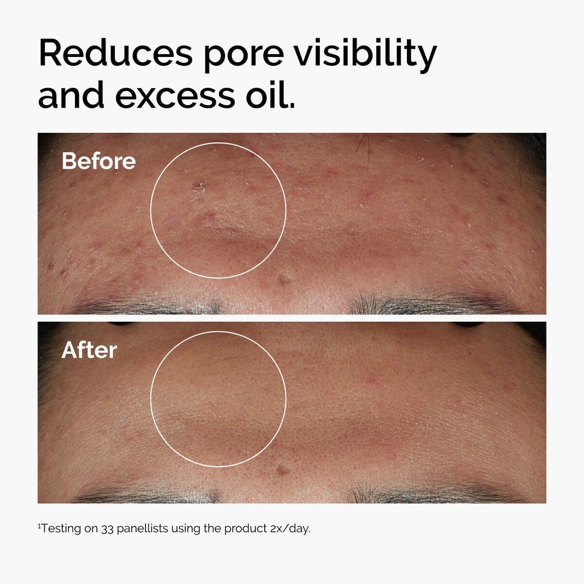 niacinamide-10-zinc-1-q2 ord-niacinamide-zinc-blemish-serum-before-after-pores.jpg