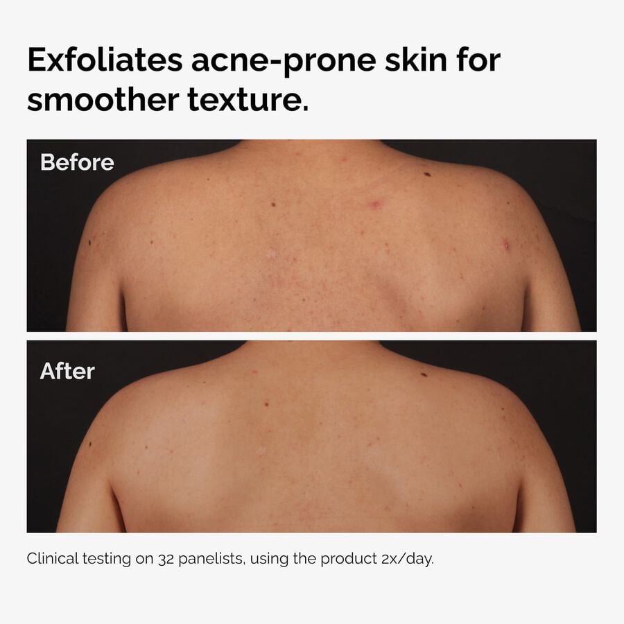the-body-care-collection-l0 ord-salicylic-acid-body-serum-before-after-graphic-NA.jpg