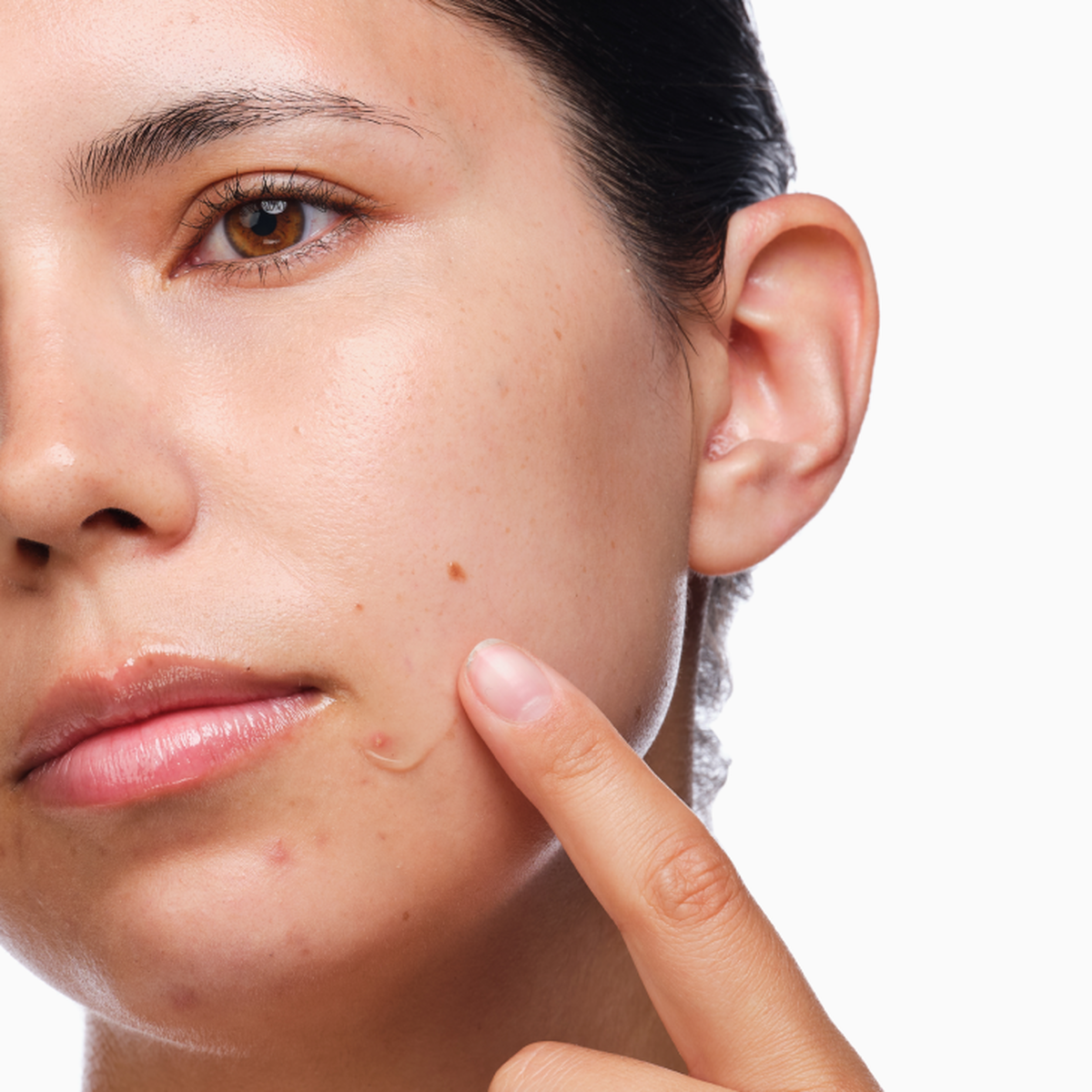 the-acne-set-h2 rdn-the-acne-set-application.png